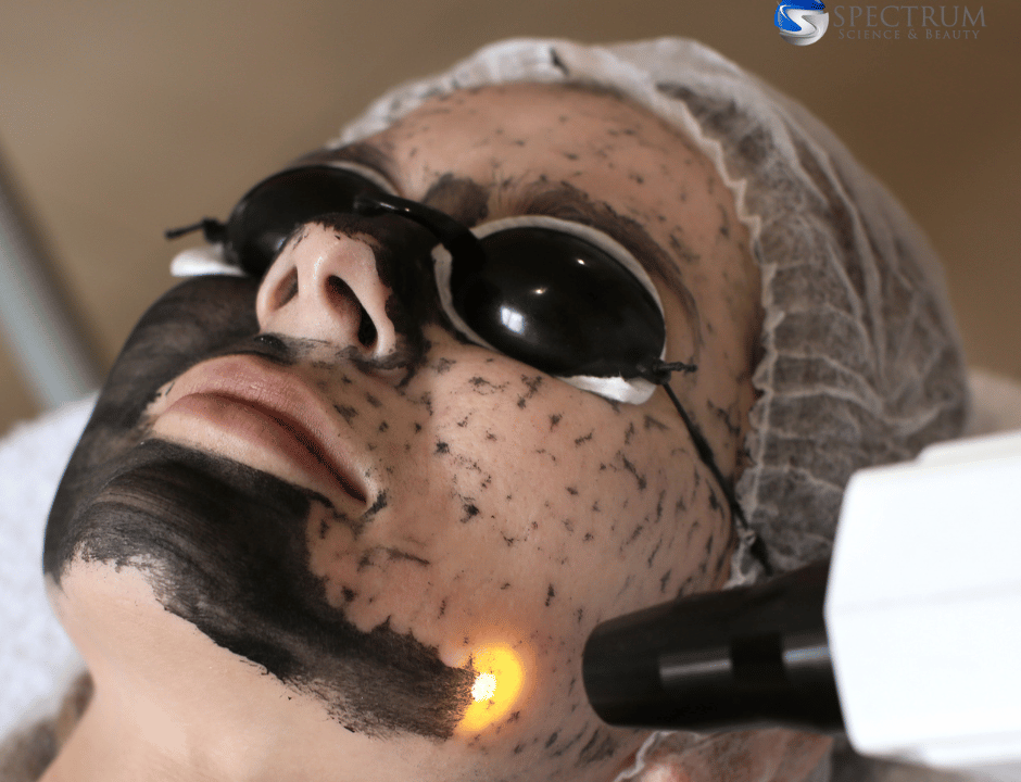 carbon laser for face